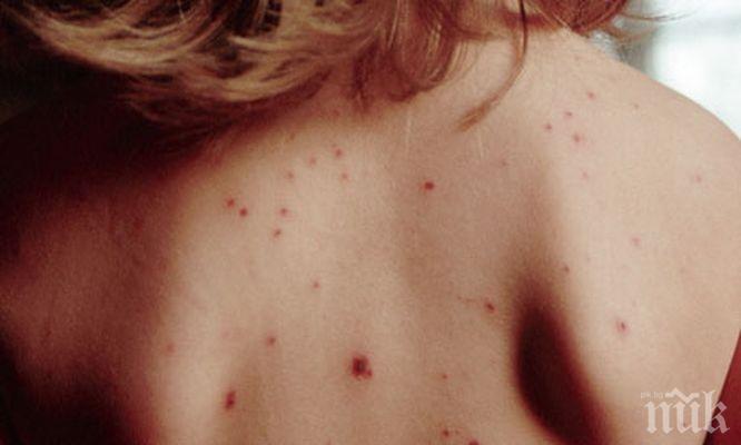 ОБРАТ: Няма заразена с морбили жена във Варна