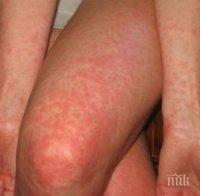 Нов случай на морбили в Бургас - разболя се бебе от Украйна