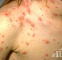 Бум на морбили в Благоевградско