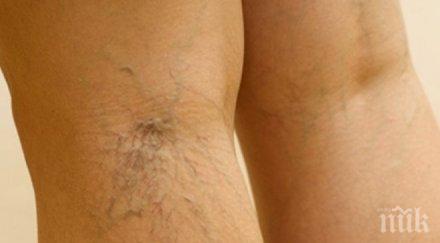 полезно съвета избегнем разширените вени