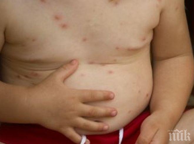 НЯМА ЕПИДЕМИЯ: По-малко болни от варицела във Варненско