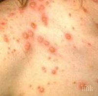 СЗО: Над 80 000 заболели от морбили в ЕС за 2018 г.