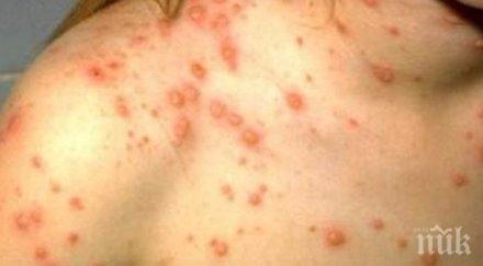 сзо 000 заболели морбили 2018