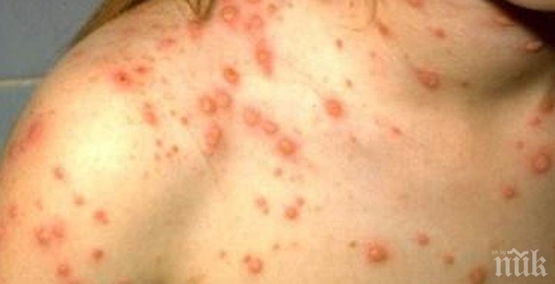 СЗО: Над 80 000 заболели от морбили в ЕС за 2018 г.