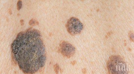 преглеждат безплатно рак кожата вма