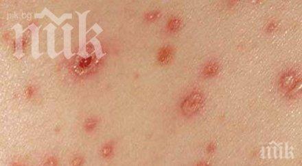варицелата тръшна болни варна