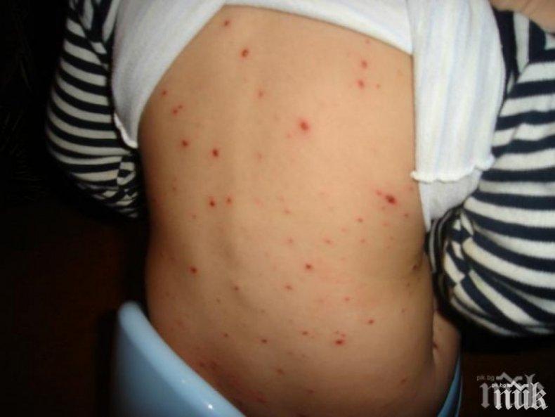 Бум на заразени с варицела в Бургаско