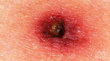 смъртоносно пловдивска клиника докараха ухапани кърлеж мъж жена тежко състояние