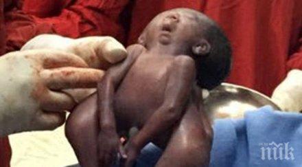 разделиха сиамски близначки свързани главите