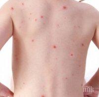 Опасно: Бум на варицела в Пловдив. Болните са се увеличили близо четири пъти за седмица