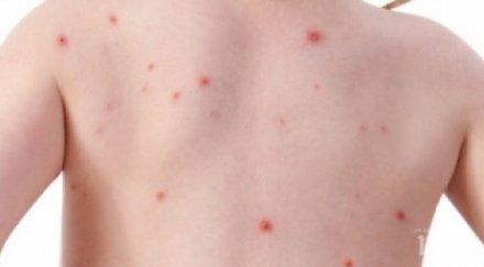 опасно бум варицела пловдив болните увеличили близо четири седмица