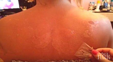 осем трика справим слънчевото изгаряне