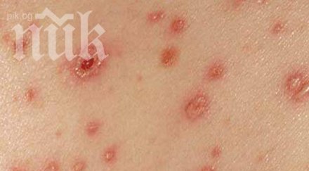 дупничанин почина тежка варицела