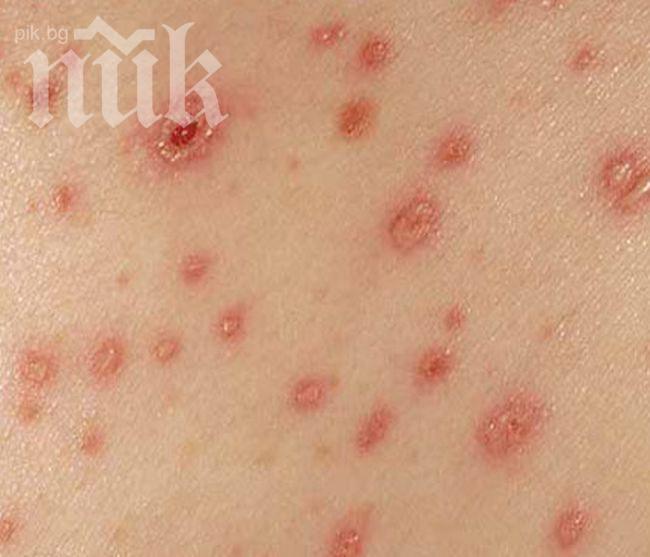 Дупничанин почина след тежка варицела