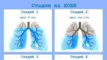Турски светила ще дават безплатни консултации по белодробни болести в София