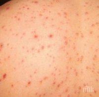 15 случая на варицела са регистрирани за седмица във Варна