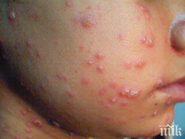 Ваксинират извънредно над 12 000 деца срещу морбили
