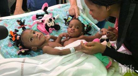 оперират сърцето една сиамските близначки разделени лион