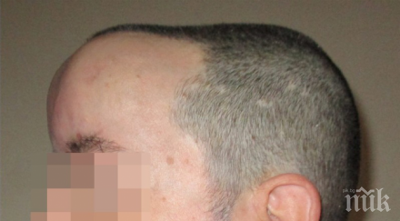 изписаха божидар чийто мозък отстраниха тумор