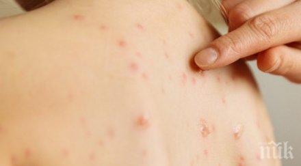 варицела върлува великотърновска област регистрираха случая