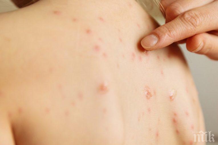 Варицела върлува във Великотърновска област, регистрираха 20 нови случая