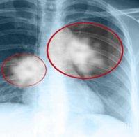 Туберкулозата нагази Смолян, три случая само за седмица