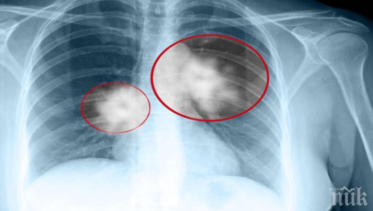 Туберкулозата нагази Смолян, три случая само за седмица