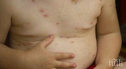 бум варицела монтанско