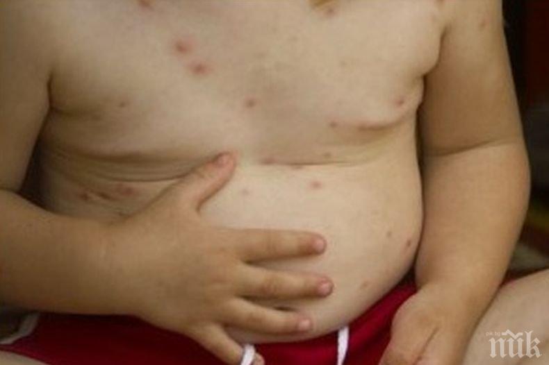 РЗИ: Бум на заразени с варицела деца във Великотърновско