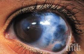 безплатно преглеждат глаукома