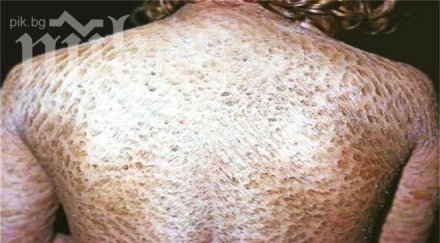 рядка болест кара две сестри сменят кожата всеки ден