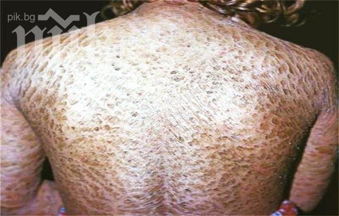 Рядка болест кара две сестри да сменят кожата си всеки ден