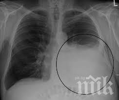 НЕОБРАТИМИ ПОРАЖЕНИЯ: Първият, преживял COVID-19 в Севастопол, е изписан само с 30% от белите си дробове
