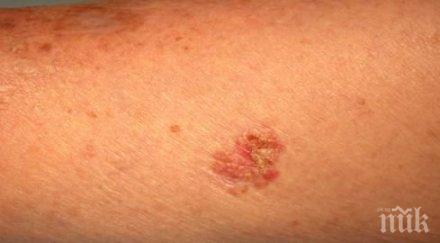 опасно всяко слънчево изгаряне риск кожен рак