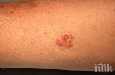 ОПАСНО: Всяко слънчево изгаряне е риск за кожен рак