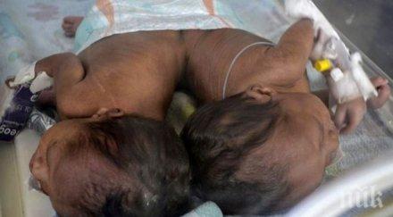 успешно разделиха сиамски близначки италия