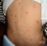 Учени с невероятно откритие: Викингите са първите разпространители на едрата шарка