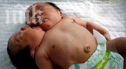 бебе родено две глави претърпя успешна операция