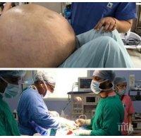 НАЙ-ГОЛЕМИЯТ В СВЕТА: Лекари отстраниха 54-килограмов тумор