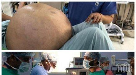 големият света лекари отстраниха килограмов тумор