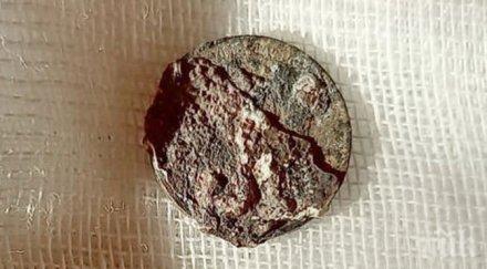 извадиха носа пациент монета стояла повече години