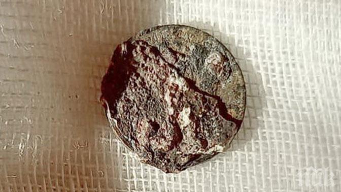 Извадиха от носа на пациент монета, стояла там повече от 50 години