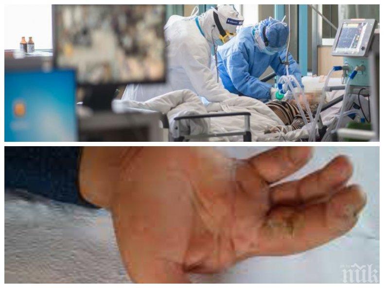 Баща на две деца оцеля, след като заради COVID-19 загуби пръстите на ръцете и зрението си
