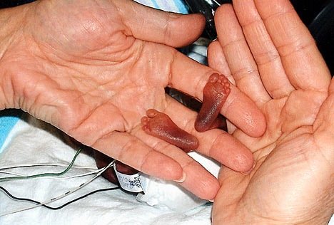 Пловдивски професор иска затягане на абортите по желание