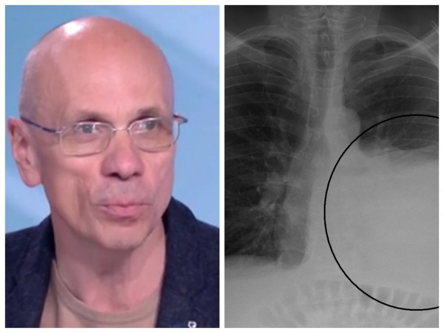 Топ кардиолог обясни как да разберем увреден ли е необратимо белият ни дроб от COVID-19