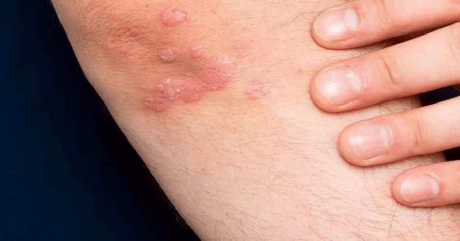 РИСК: COVID-19 обостря хроничните кожни заболявания като псориазис
