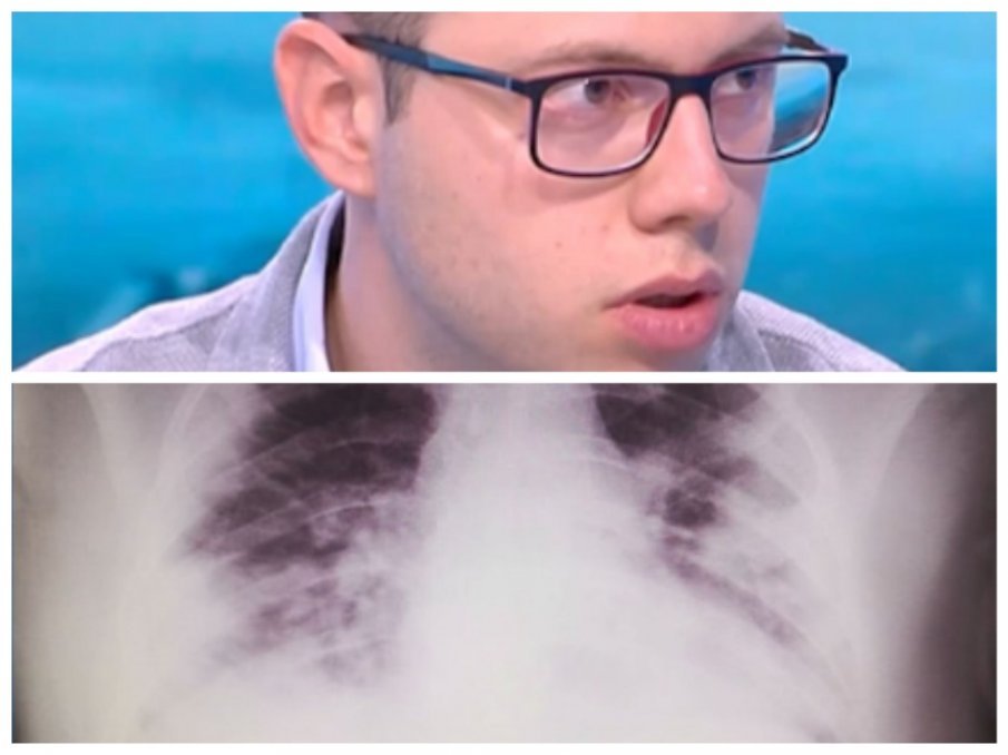 Лекар показа снимка на белите дробове на починал млад мъж от COVID-19 и апелира: Не вярвайте на врели-некипели!