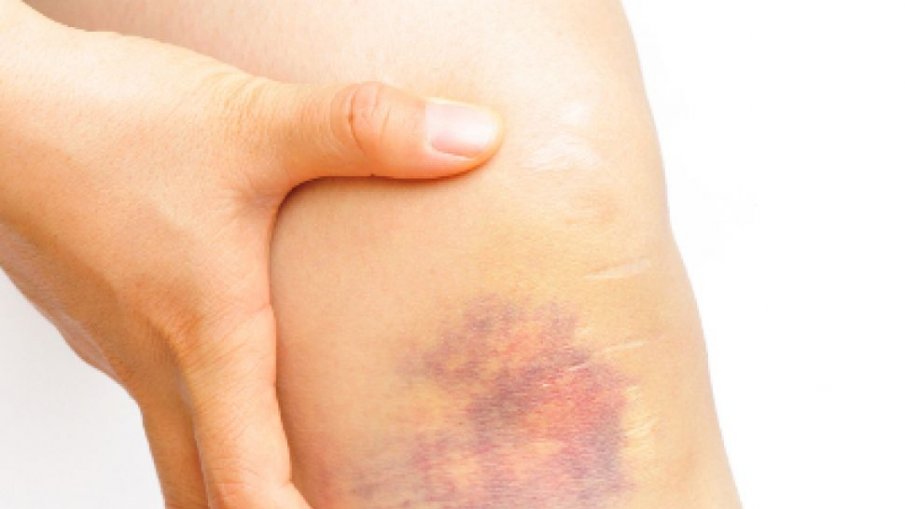 Посиняване на ноктите, устните и кожата са явни симптоми за Омикрон