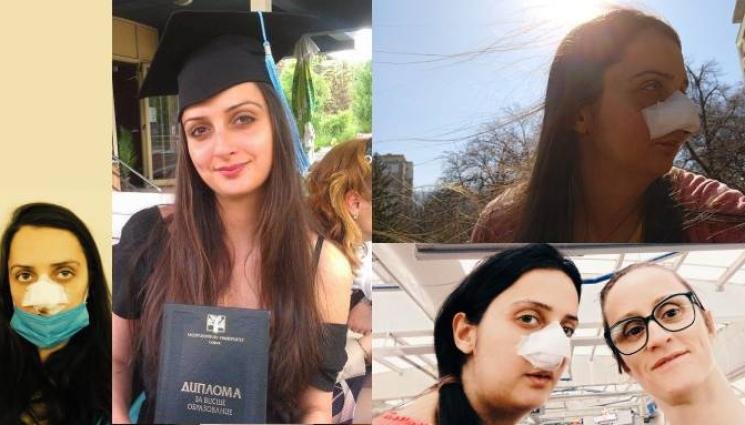 ЛИЧНА ДРАМА: Куче отхапа носа на фотографка в Кюстендилско, събират 150 000 лева за операция