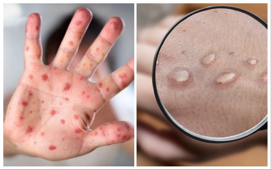 КАКВО СЕ СЛУЧВА: Първи случаи на маймунска шарка при деца